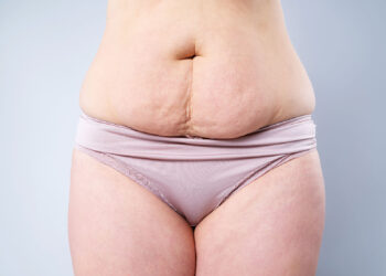 Diastasis recti nedir?